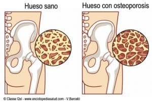 osteoporosis-